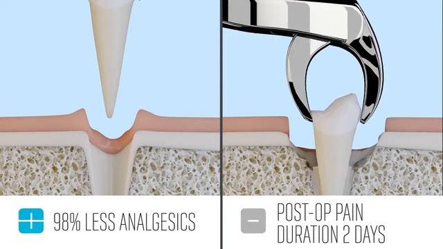 Преимущества насадок Piezo для пьезохирургического аппарата Piezotome CUBE при удалении зуба смотреть онлайн