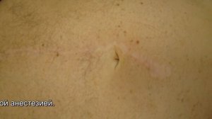 устранение паховой грыжи 107 1