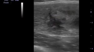 Внутримышечный разрыв четырехглавой мышцы бедра