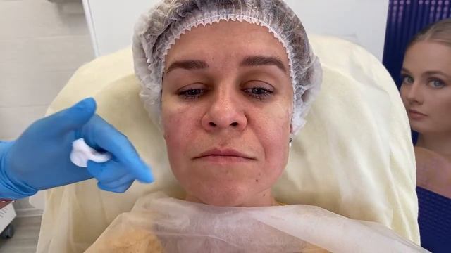 Коррекция скуловой области (скулы) смотреть онлайн