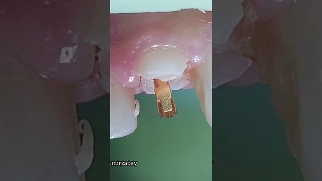 tooth restoration with metal pins | Реставрация зуба