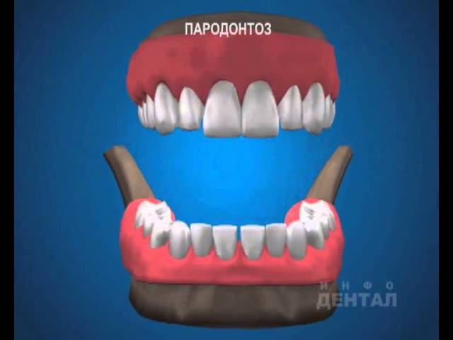 Пародонтоз