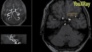 Анатомия магистральных артерий головного мозга на примере нативных МР-артериограмм. Виллизиев круг