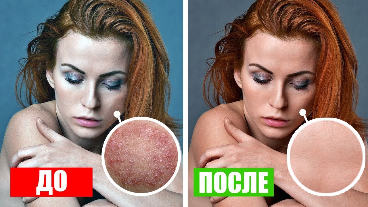 Очищение Организма От Паразитов, Грибков, Плесени