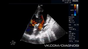 ЭхоКГ Пример 2 - Трехкамерное сердце (большой дефект межжелудочковой перегородки)