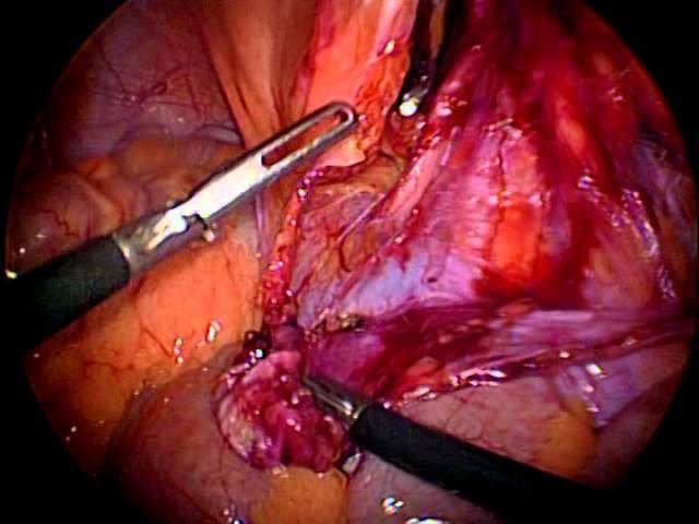 Laparoscopic ТАРР Abolmasov A. (паховая грыжа) смотреть онлайн