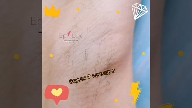 Электроэпиляция