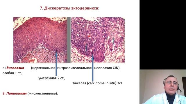 Патанатомия 13. Заболевания женских половых органов и молочных желез смотреть онлайн