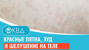 ? Красные пятна, зуд и шелушение на теле. Клинический случай №734
