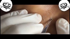 УДАЛЕНИЕ БОЛЬШИХ ЧЕРНЫХ ТОЧЕК И ПРЫЩЕЙ (МЕРЗКО)