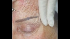 Plasma Pen Clinic   Fibroblast Eyelid & Brow Lifting