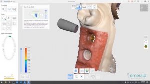 Aligning Scan Bodies with Medit i500
