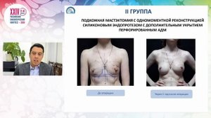 Реконструкция молочной железы имплантом одноэтапная