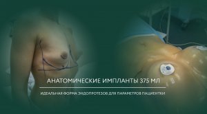 Эндопротезирование молочных желез анатомическими имплантами 375 мл