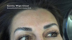 Brow Lift Procedure, eyebrow lift Demo