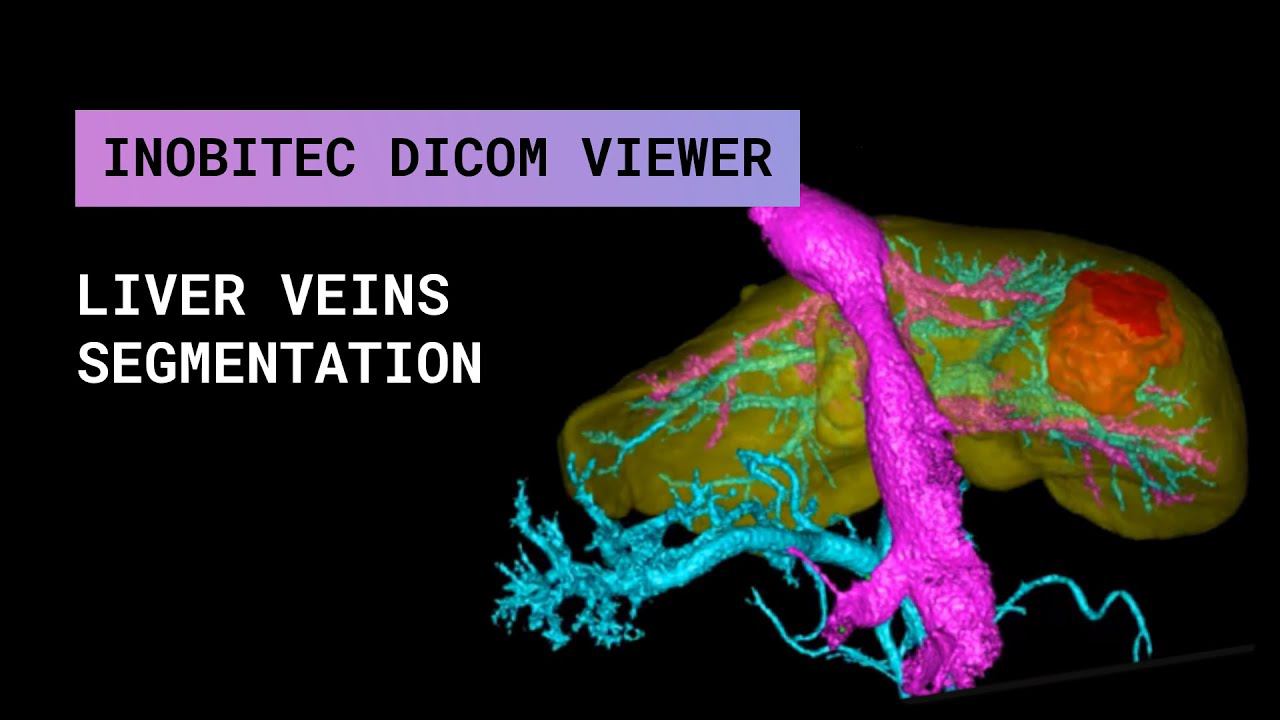 Сегментация вен печени в Inobitec DICOM Viewer Pro 2.3