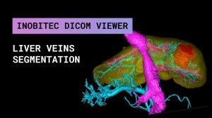 Сегментация вен печени в Inobitec DICOM Viewer Pro 2.3