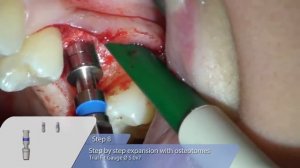 OT medical: OT-F3 Implant-Insertion with Sinus Lift-Osteotomy