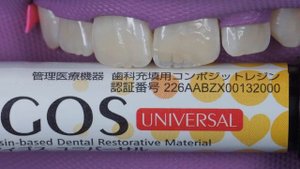 Реставрация переднего зуба. Замена старой пломбы. Front tooth restoration.