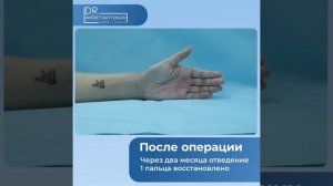 Травма сухожилия большого пальца. результат лечения.