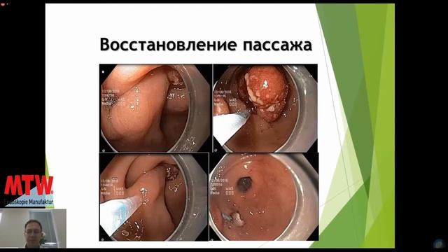 Гиперпластические полипы желудка: удалять или не удалять?