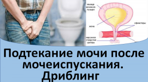 Подтекание мочи после мочеиспускания. Дриблинг