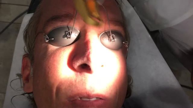 Excel V Treatment of Nasal Vessels/Broken Capillaries смотреть онлайн