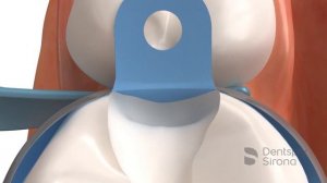 Матричная система PalodentV3_как пользоваться