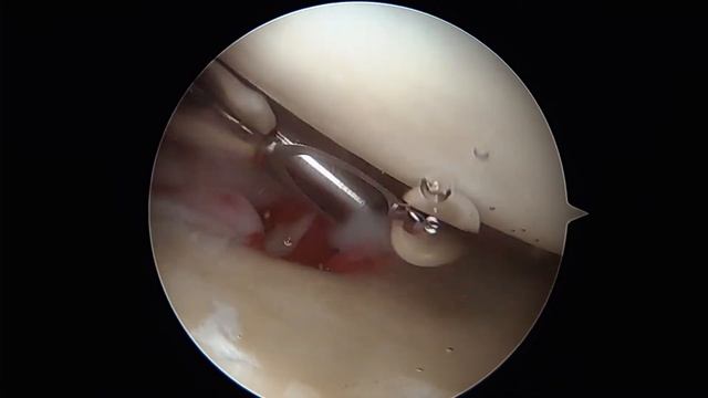 Right shoulder type 3 SLAP lesion and subpectoral biceps tenodesis смотреть онлайн