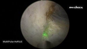 HoLEP. Лазерная энуклеация аденомы объемом 60 см³. MultiPulse HoPLUS (JENA Surgical)