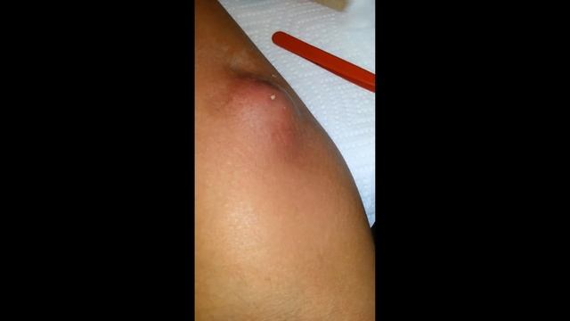 БОЛЬШОЙ ЧИРЕЙ/БОЛЬШОЙ ЧИРЯК/БОЛЬШОЙ ПРЫЩ/БОЛЬШОЙ ГНОЙНИК