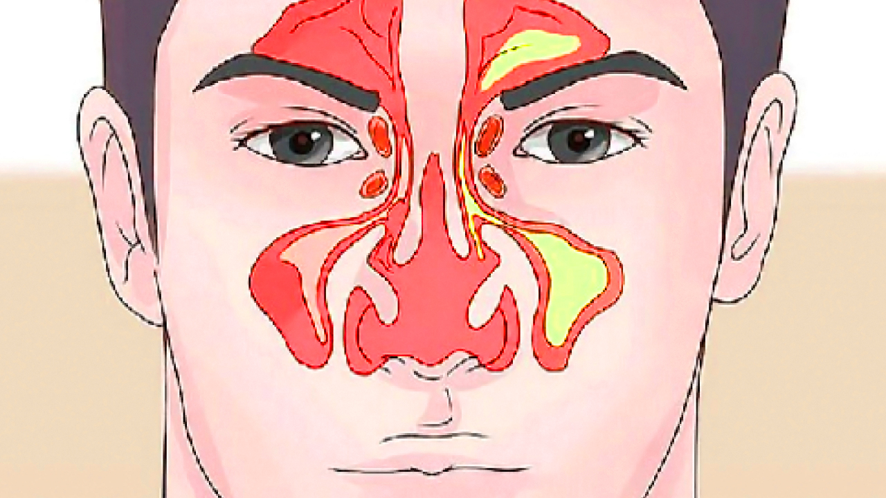 Хроническая заложенность носа у взрослых. Строение носа при насморке.