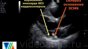 Склероз ЗСМК похож на инфаркт и кардиосклероз