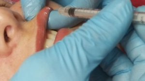 ГУБЫ ,,чайка,,. Коррекция ТОКСИНОМ.