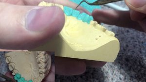 Коррекция передних зубов. Моделирование зубов из воска, серия видео роликов моделировки зубов.