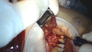 ОТКРЫТЫЙ СИНУС-ЛИФТИНГ \ LATERAL SINUS-LIFT