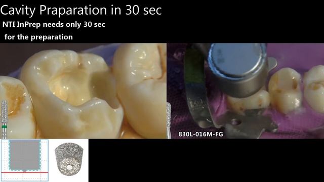 Препарирование зуба. InPrep против обычных боров смотреть онлайн