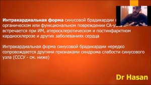 синусовая брадикардия