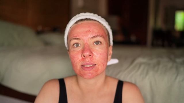 Кровавый пилинг The Ordinary AHA 30% + BHA 2% Peeling Solution | Отшелушивание | Прыщи | Проблемная