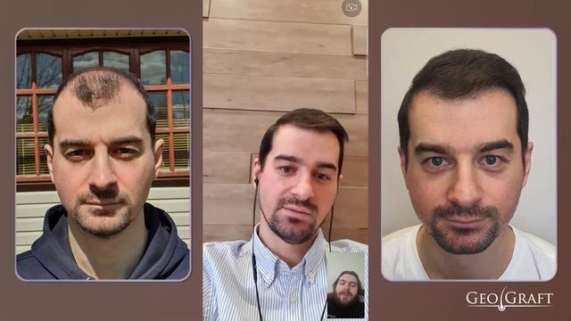 Видео отзыв от Владимира после пересадки волос .Географт /Geograft. смотреть онлайн