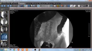 ИРРИГОСКОПИЯ  ИРРИГОГРАФИЯ  РЕНТГЕНОГРАФИЯ  делать или нет .