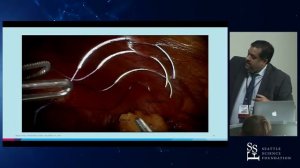 09-Reducing Warm Ischemia Time During Robotic Partial Nephrectomy Presented by Ketan Badani, MD