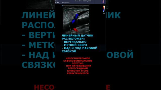 Как выглядит НЕСОСТОЯТЕЛЬНОСТЬ сафенофеморального соустья на УЗИ? смотреть онлайн