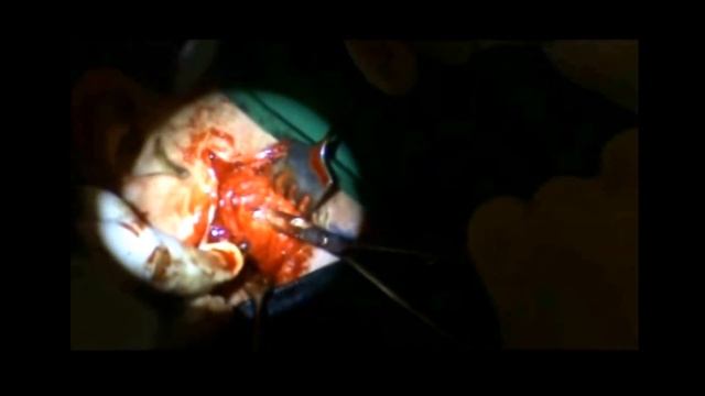 Rzayev R.M. Аденома околоушной слюнной железы смотреть онлайн