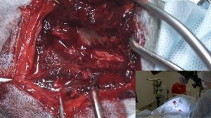 Субарахноидальный дивертикул.