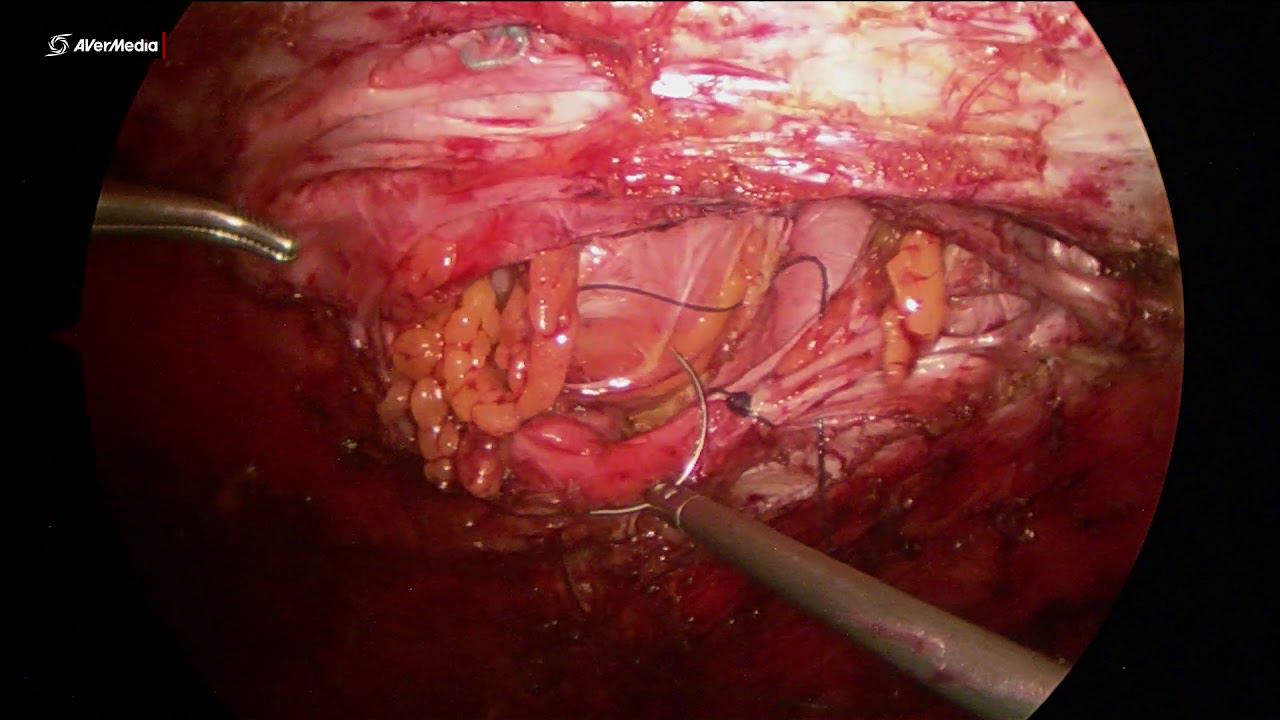 laparoscopic incisional recurrent hernia + diastasis correction eTEP+partial one side TAR смотреть онлайн