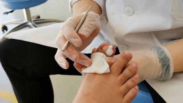 How to treat paronychia correctly смотреть онлайн