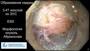 Удаление лейомиомы методом EMR. Опыт городского клинического онкологического диспансера, г. СПб