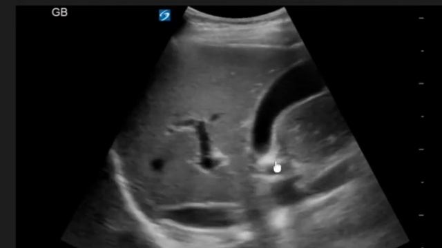 Желчный пузырь. УЗИ. Норма. смотреть онлайн