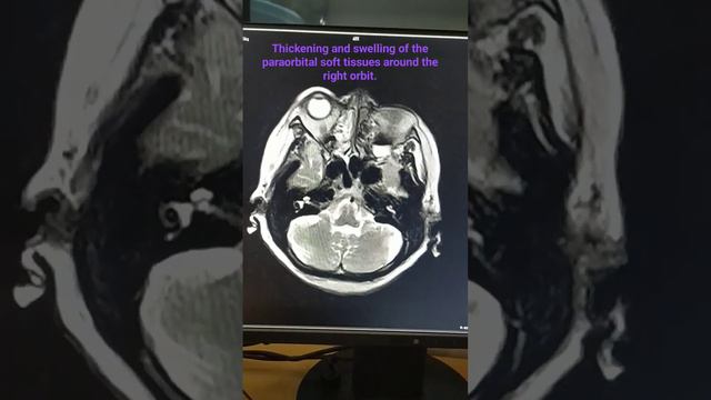 Thickening and swelling of the paraorbital soft tissues around the right orbit.